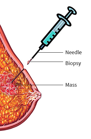 Ganga Breast Care