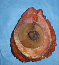 Breast cancer care